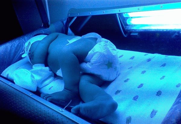 лечение желтухи у нворожденных детей
