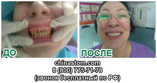 востановленние зубов